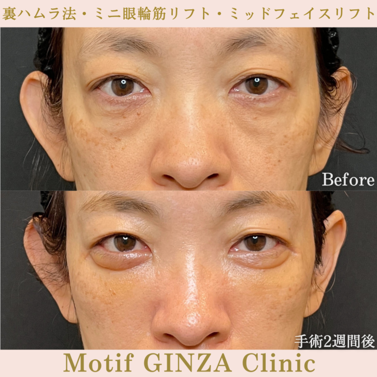 裏ハムラ法・ミニ眼輪筋リフト・ミッドフェイスリフト（手術３か月）の写真5