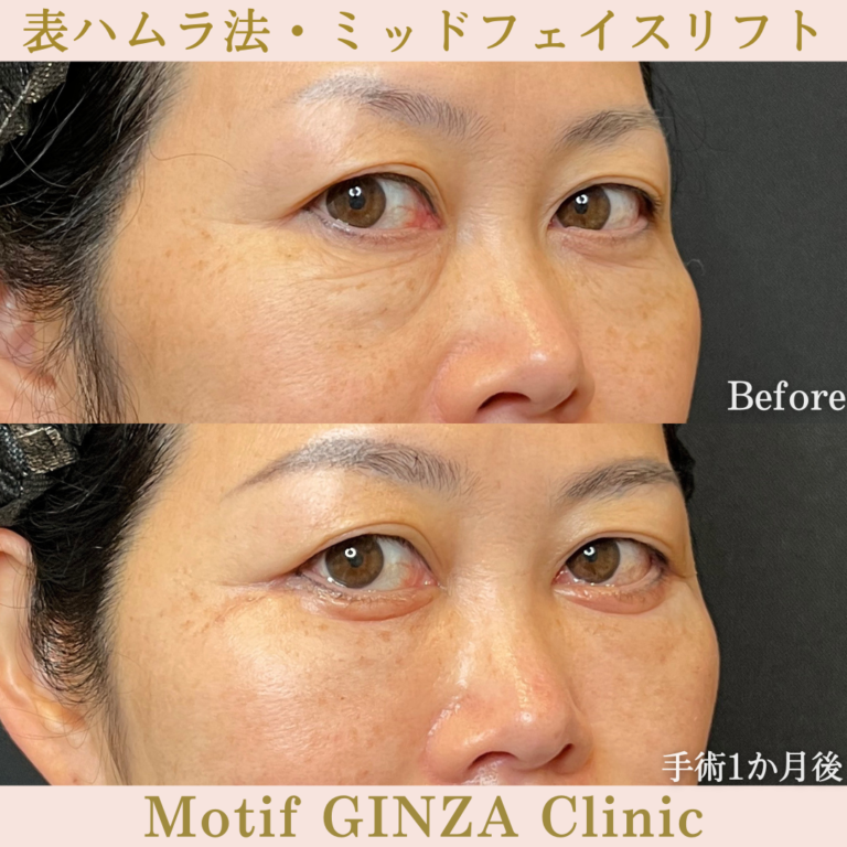 表ハムラ法・ミッドフェイスリフト(手術6か月)の写真6