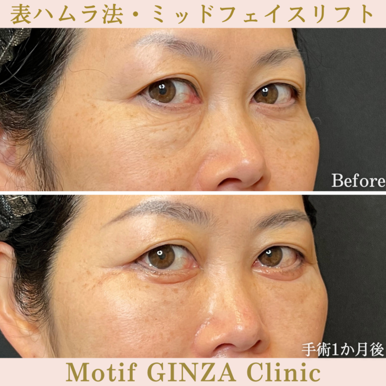 表ハムラ法・ミッドフェイスリフト（手術1か月）の写真2