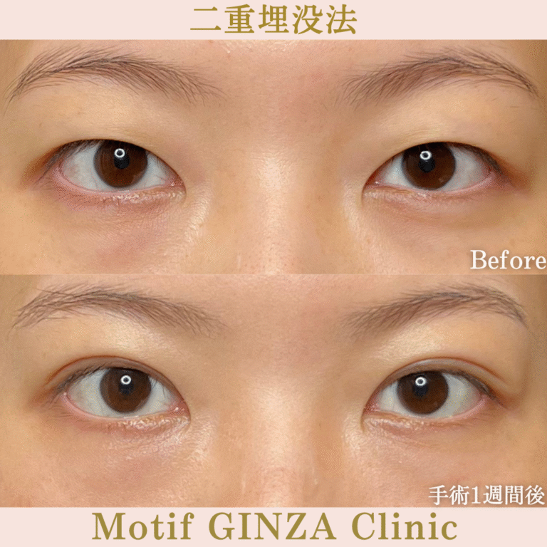 二重埋没法（手術１か月）の写真2