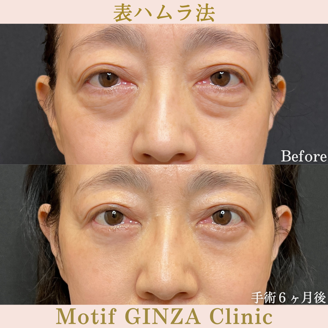 切開式下眼瞼たるみ取り（手術６ヶ月）の写真