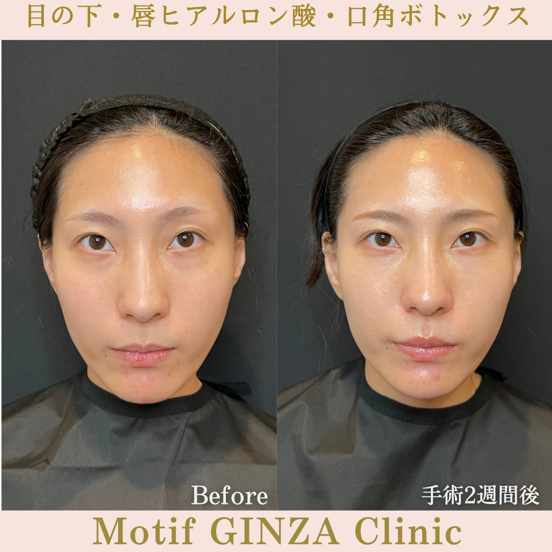 目の下・唇ヒアルロン酸・口角ボトックス（手術１か月）の写真3