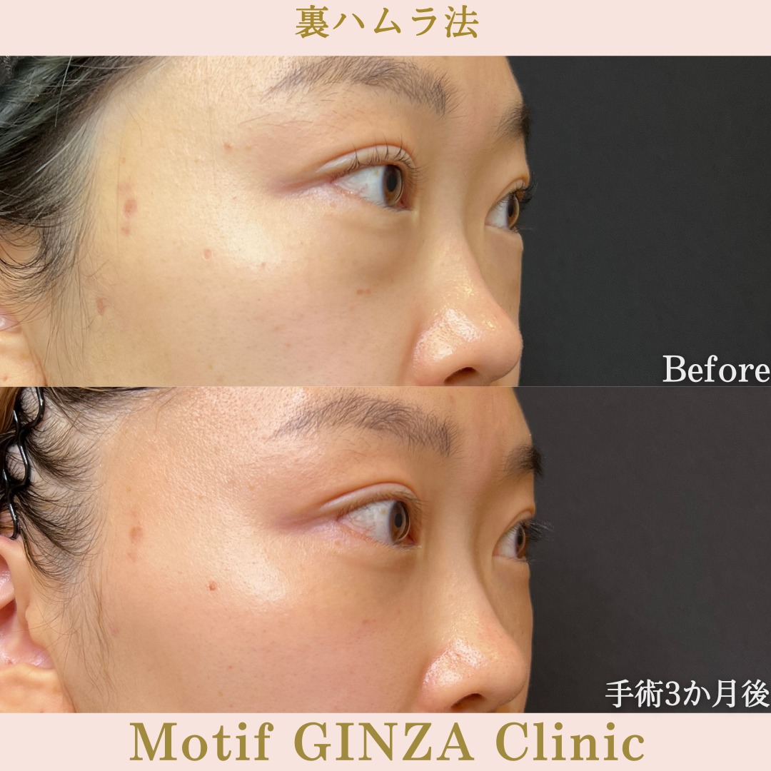 裏ハムラ法（手術１年９か月）の写真4