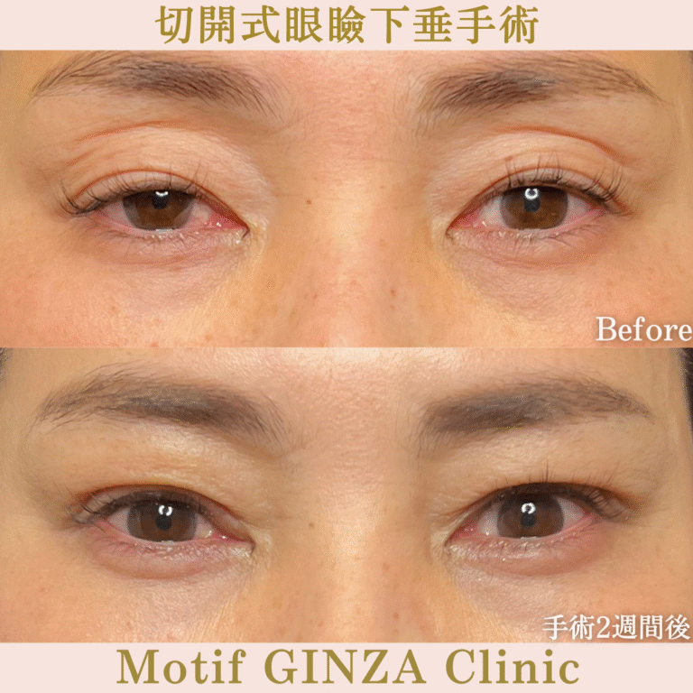 切開式眼瞼下垂手術（手術６か月）の写真5