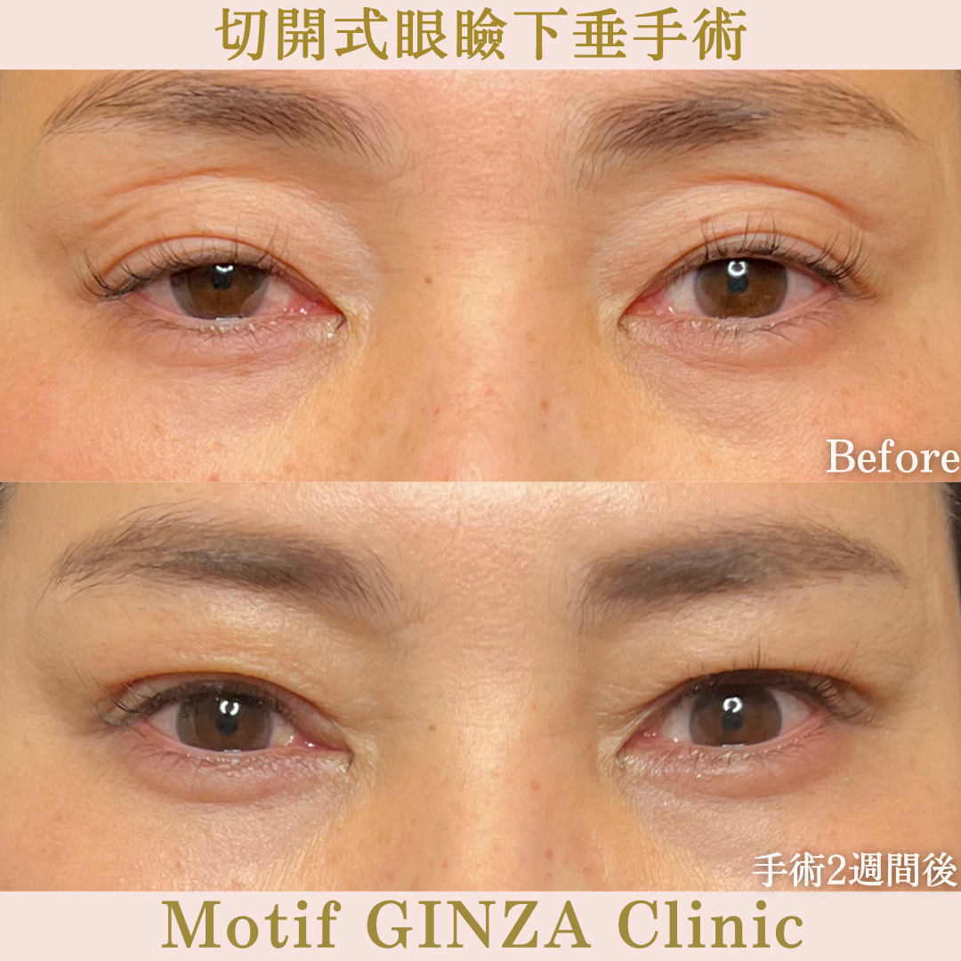 切開式眼瞼下垂手術（手術６か月）の写真5