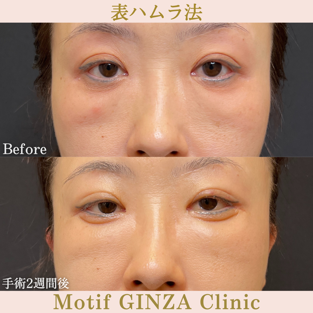 切開式下眼瞼たるみ取り(手術6ヶ月)の写真5