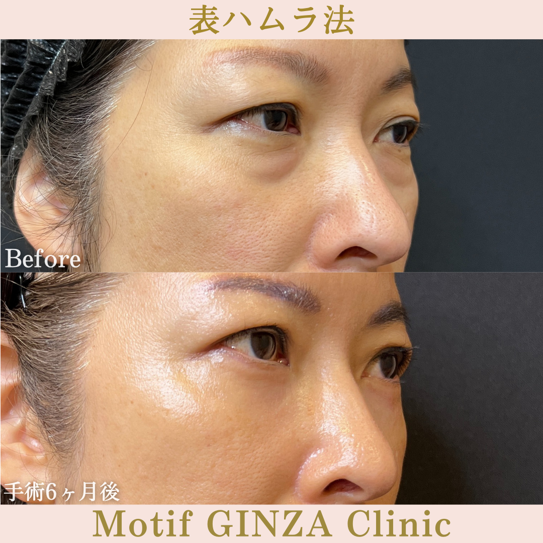 切開式下眼瞼たるみ取り(手術3ヶ月)の写真2