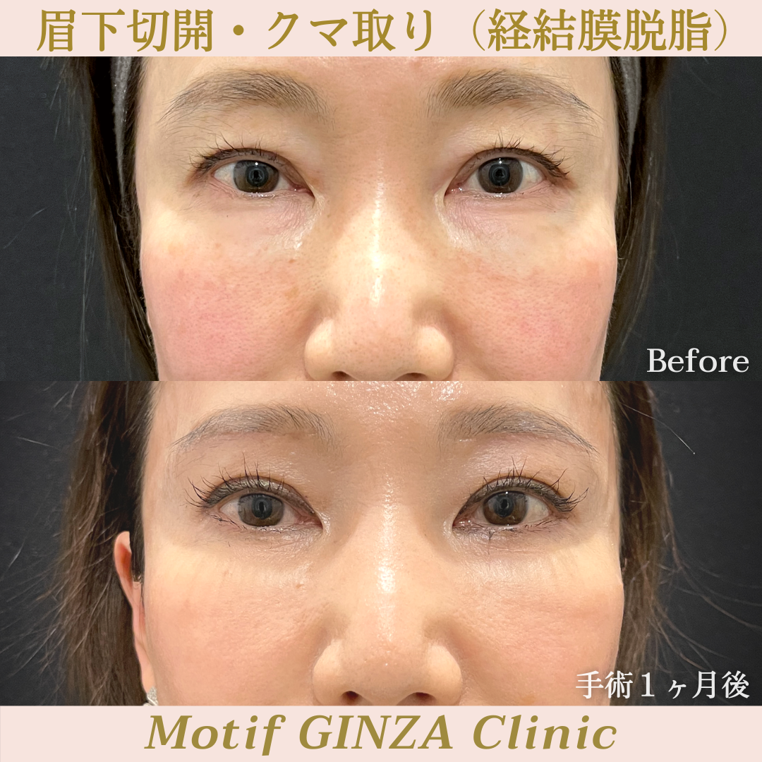 眉下切開・経結膜脱脂（手術７ヶ月）の写真4