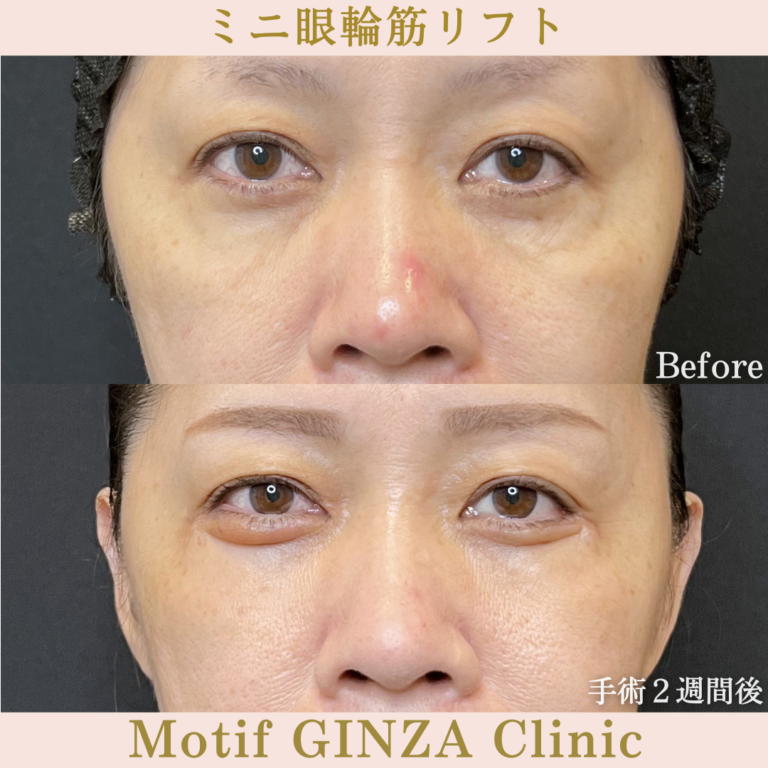ミニ眼輪筋リフト（手術３か月）の写真5
