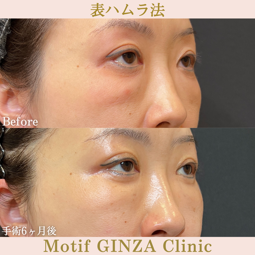 切開式下眼瞼たるみ取り(手術6ヶ月)の写真2