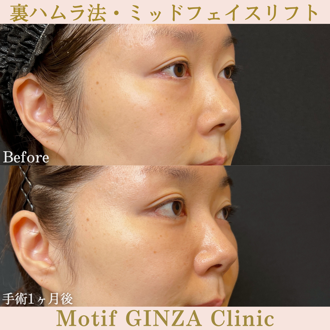 裏ハムラ法・ミッドフェイスリフト（手術１ヶ月）の写真2