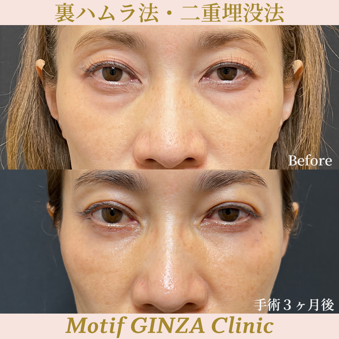 裏ハムラ法・二重埋没法（手術３ヶ月）の写真