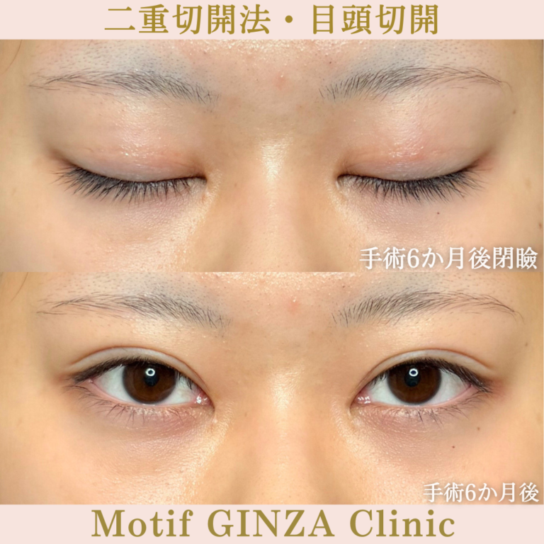 二重切開法・目頭切開(手術6か月)の写真2
