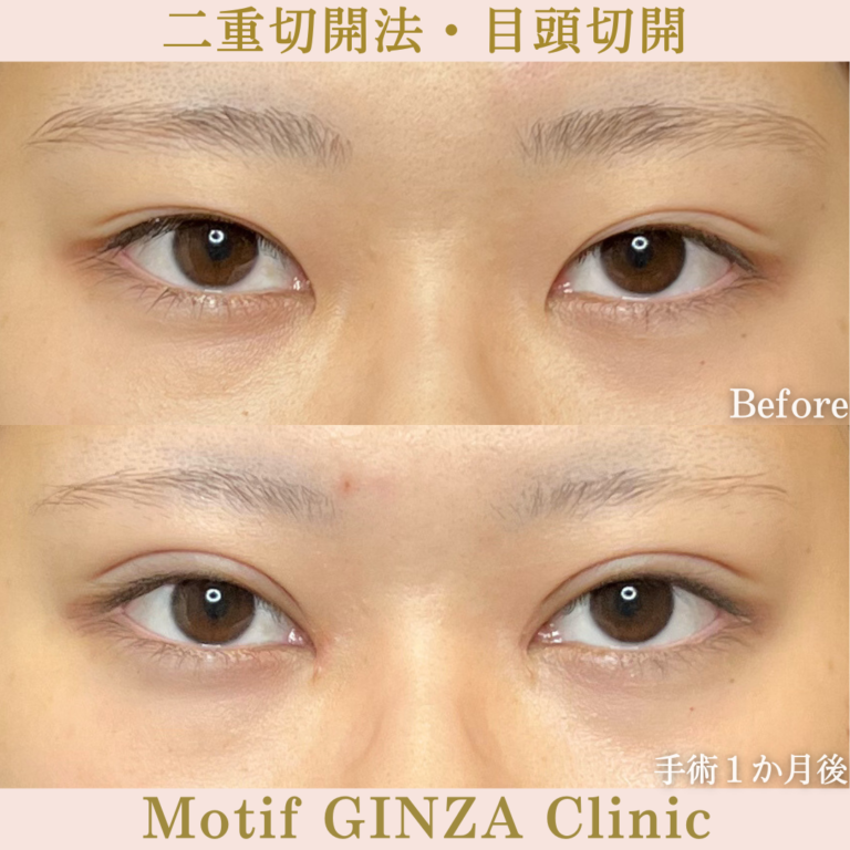 二重切開法・目頭切開（手術３か月）の写真2