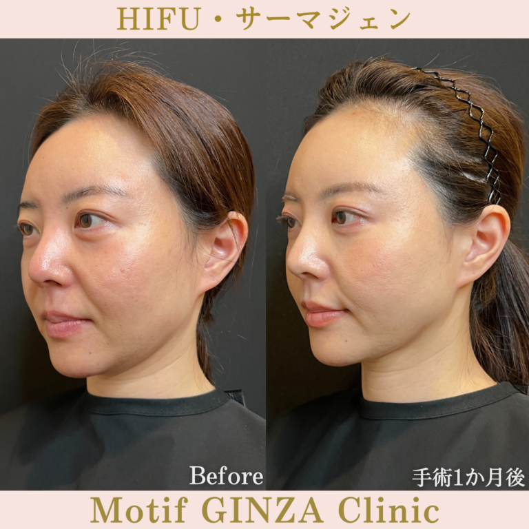 HIFU・サーマジェン(手術1か月)の写真2
