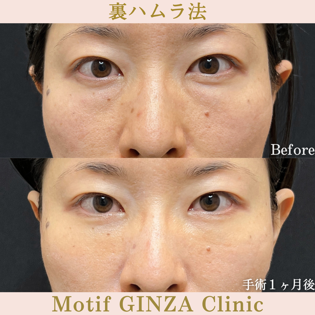 裏ハムラ法（手術３ヶ月）の写真3