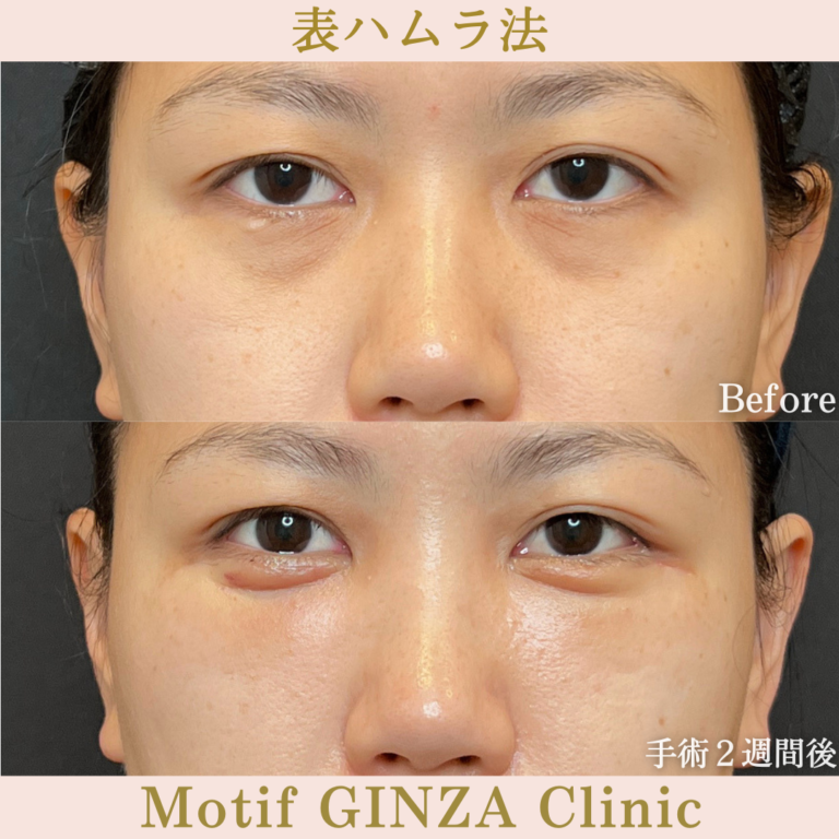 表ハムラ法（手術３か月）の写真5