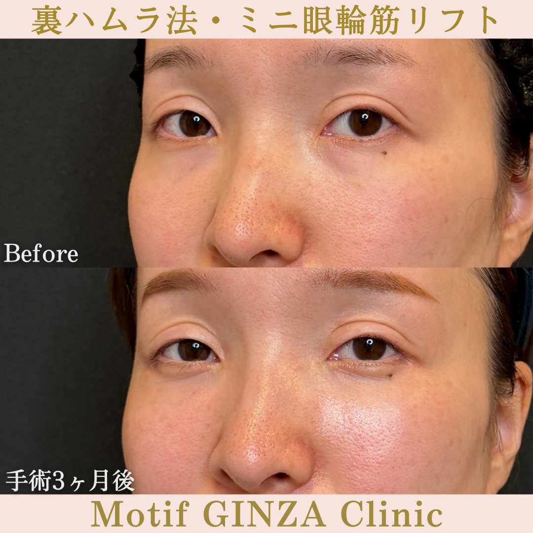 裏ハムラ法・ミニ眼輪筋リフト（手術３か月）の写真2