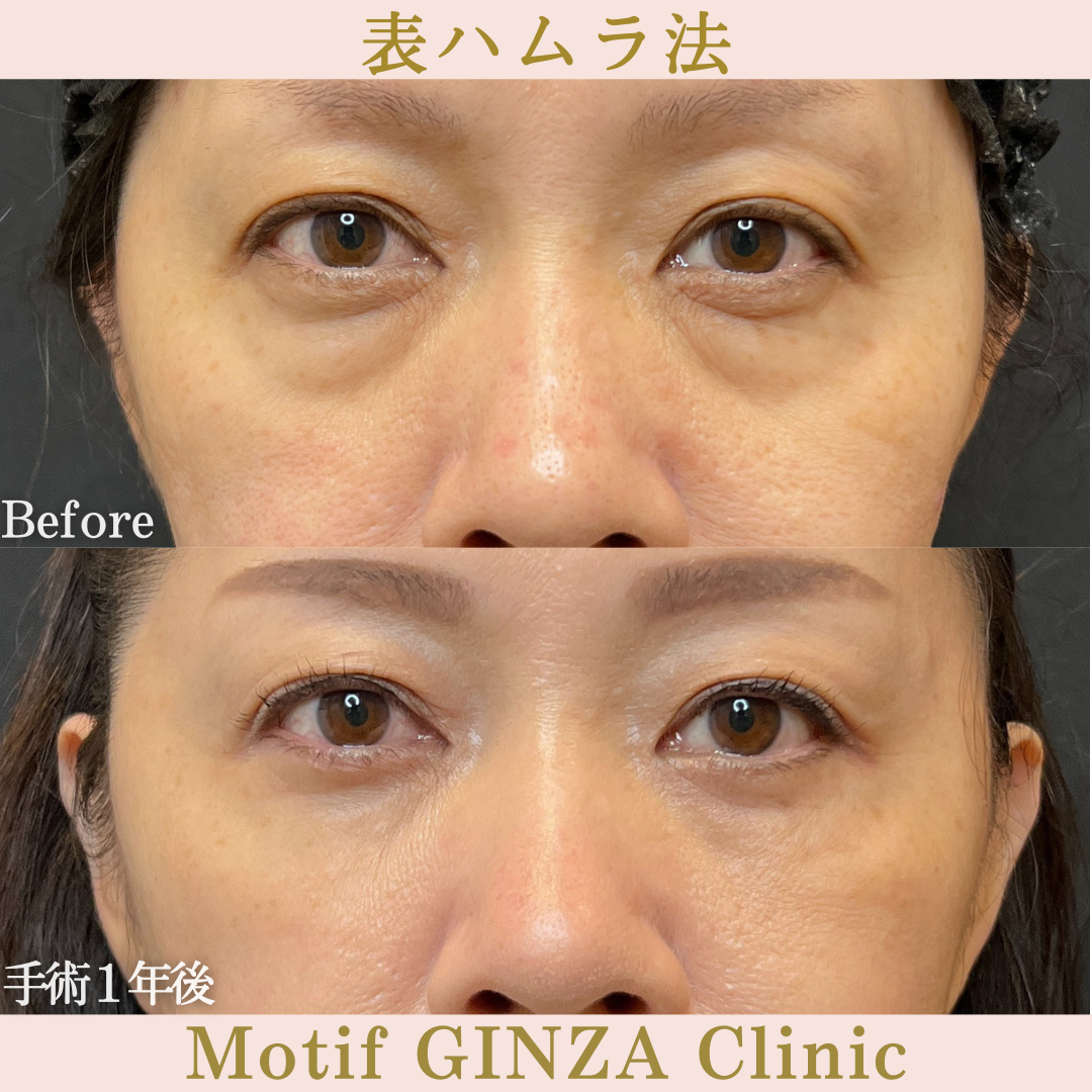 切開式下眼瞼たるみ取り(手術2年6か月)の写真3