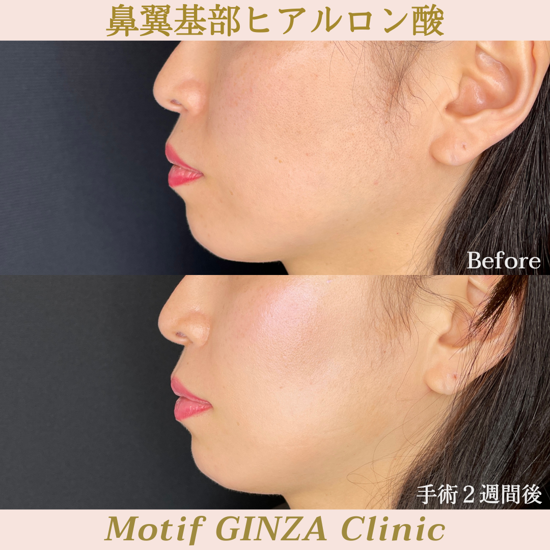 鼻翼基部ヒアルロン酸(手術2週間)の写真2