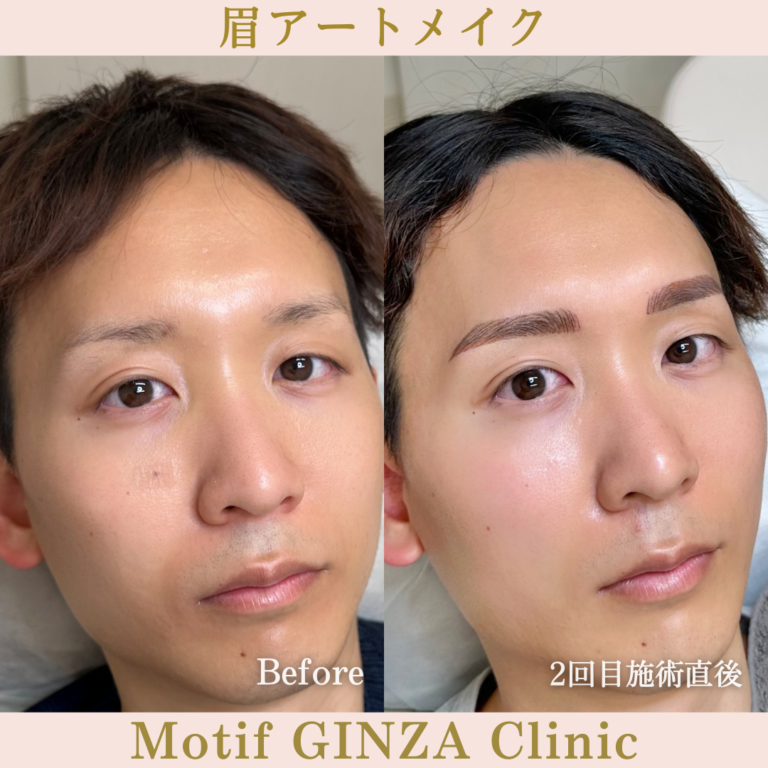 眉アートメイク（２回目施術直後）