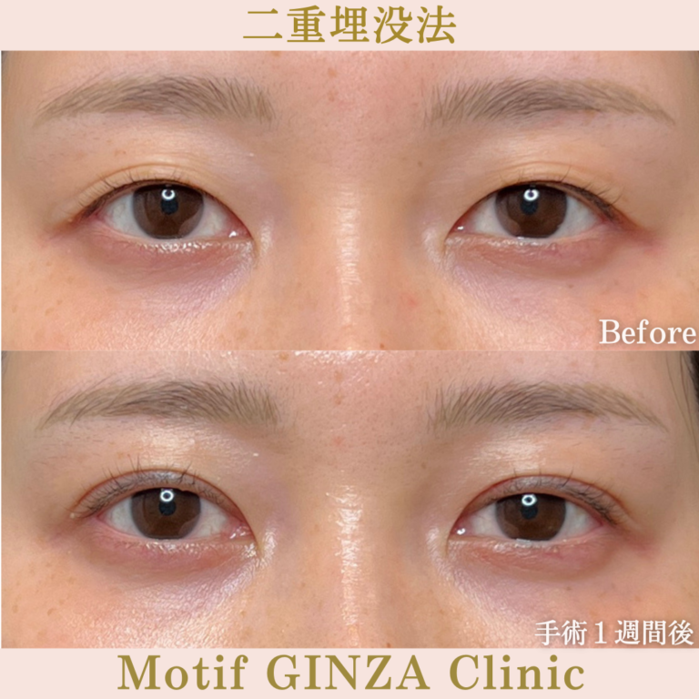 二重埋没法（手術１か月）の写真2