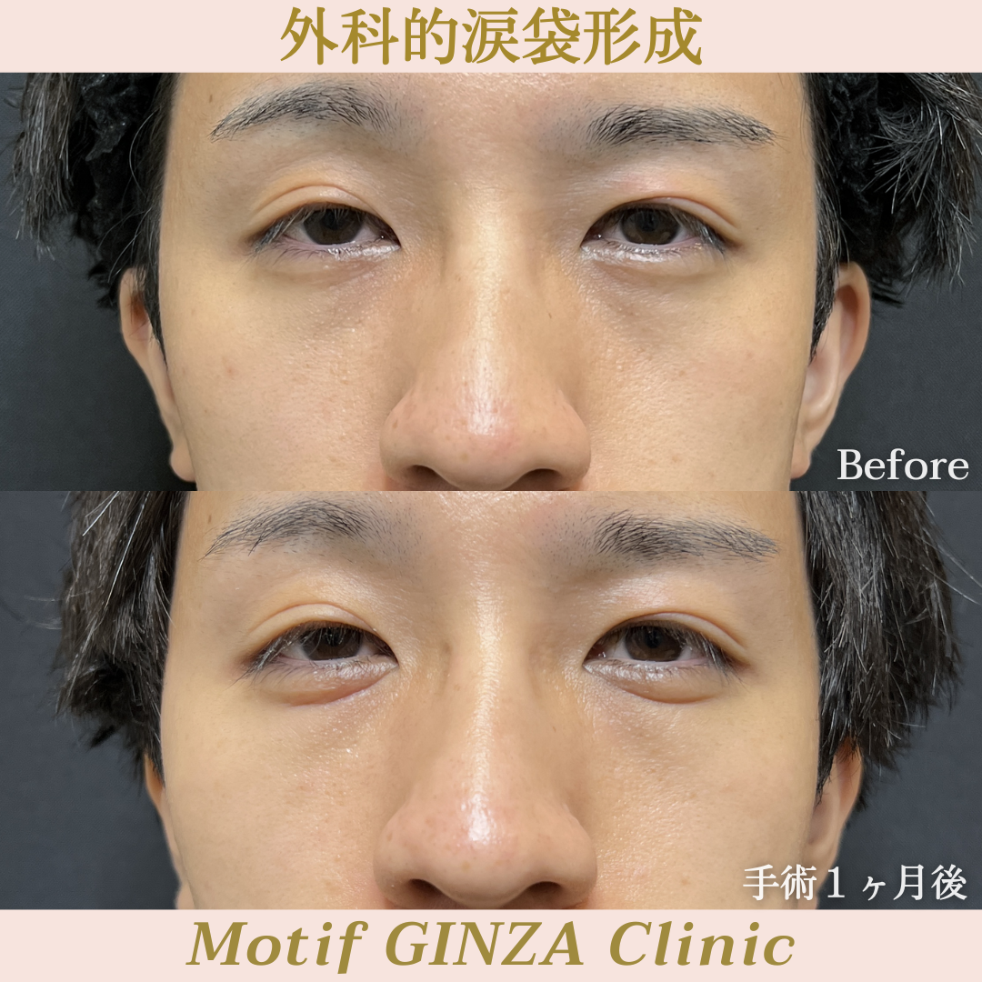 外科的涙袋形成（手術１ヶ月）の写真