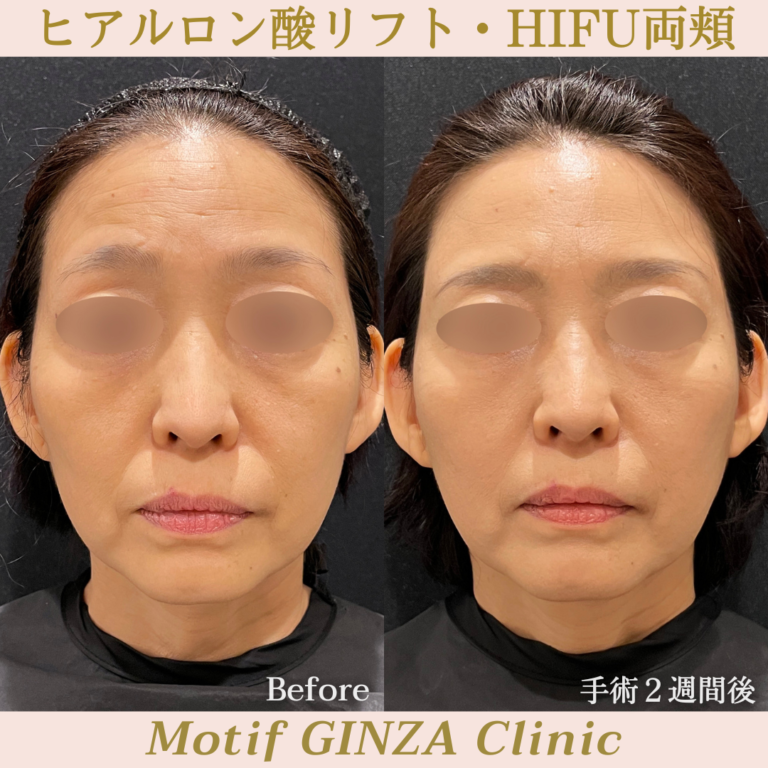 ヒアルロン酸リフト・HIFU両頬（手術２週間）の写真