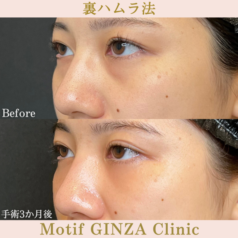 裏ハムラ法（手術３か月）の写真2