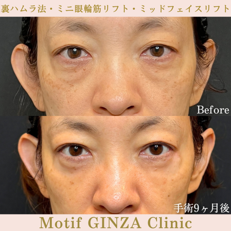 裏ハムラ法・ミニ眼輪筋リフト・ミッドフェイスリフト（手術9か月）