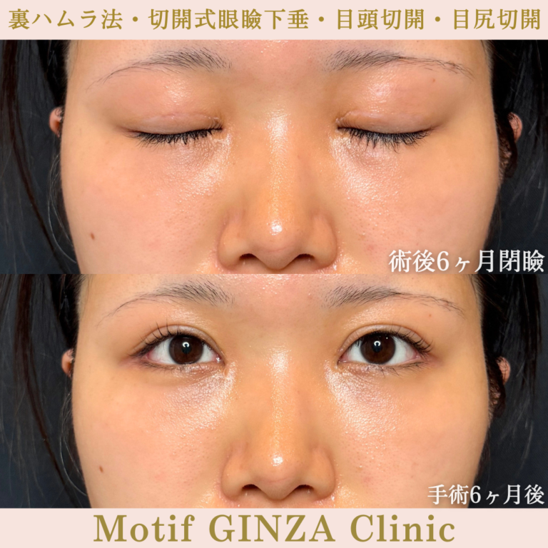 裏ハムラ法・切開式眼瞼下垂術・目頭切開・目尻切開(手術6か月)の写真2