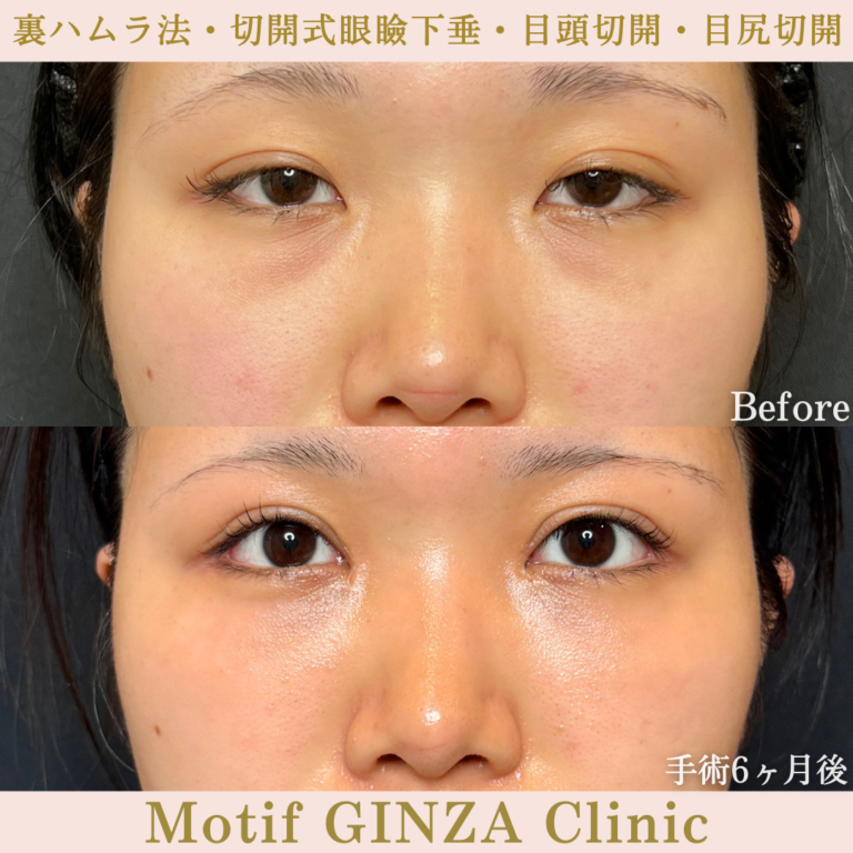 裏ハムラ法・切開式眼瞼下垂術・目頭切開・目尻切開（手術6か月）