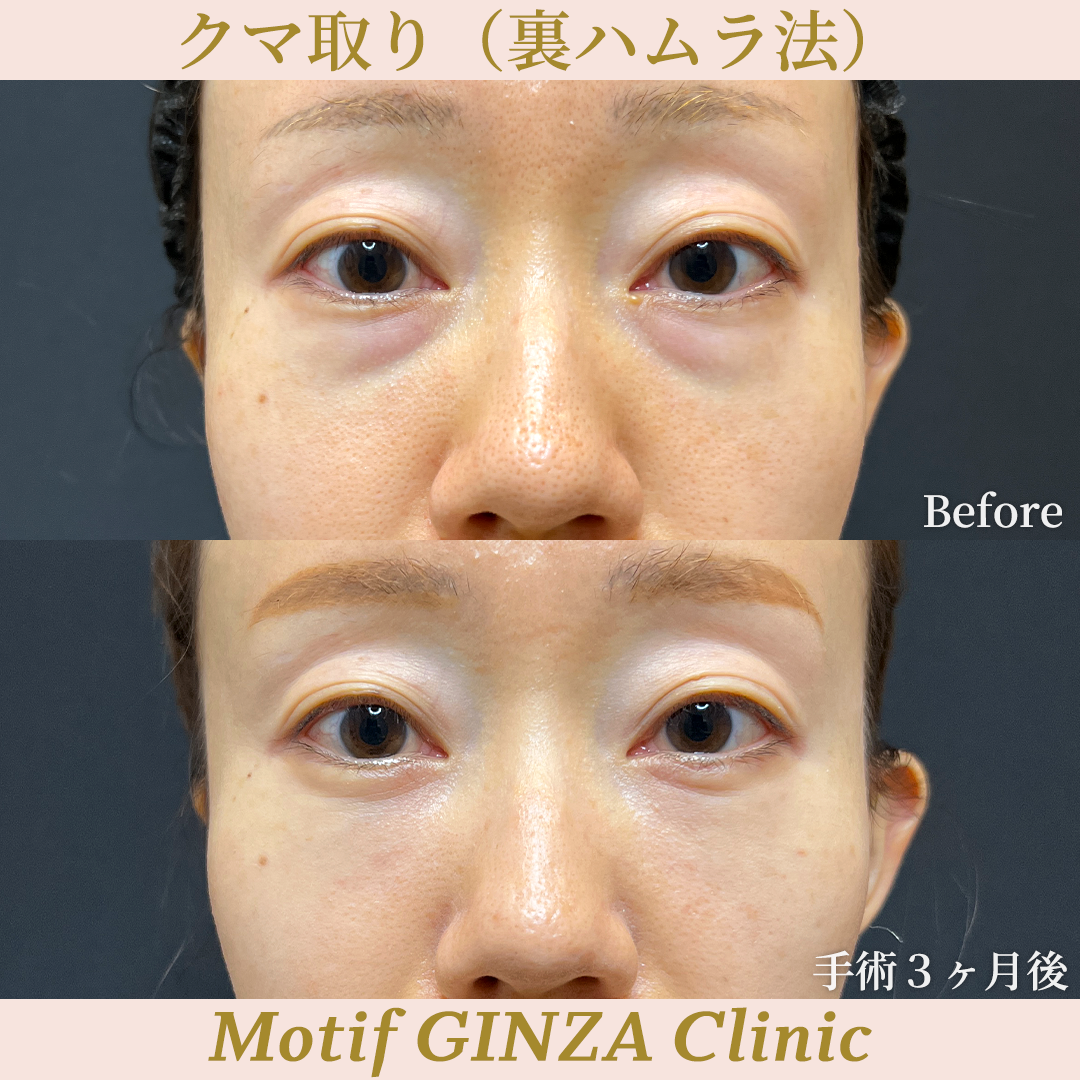 裏ハムラ法（手術２年）の写真3