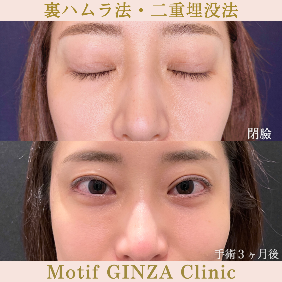 裏ハムラ法・二重埋没法（手術３ヶ月）の写真2