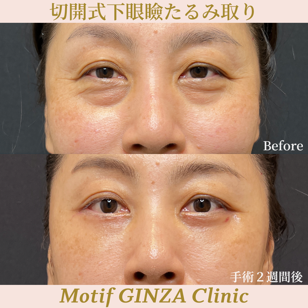 切開式下眼瞼たるみ取り（ハムラ法）（手術３ヶ月）の写真4