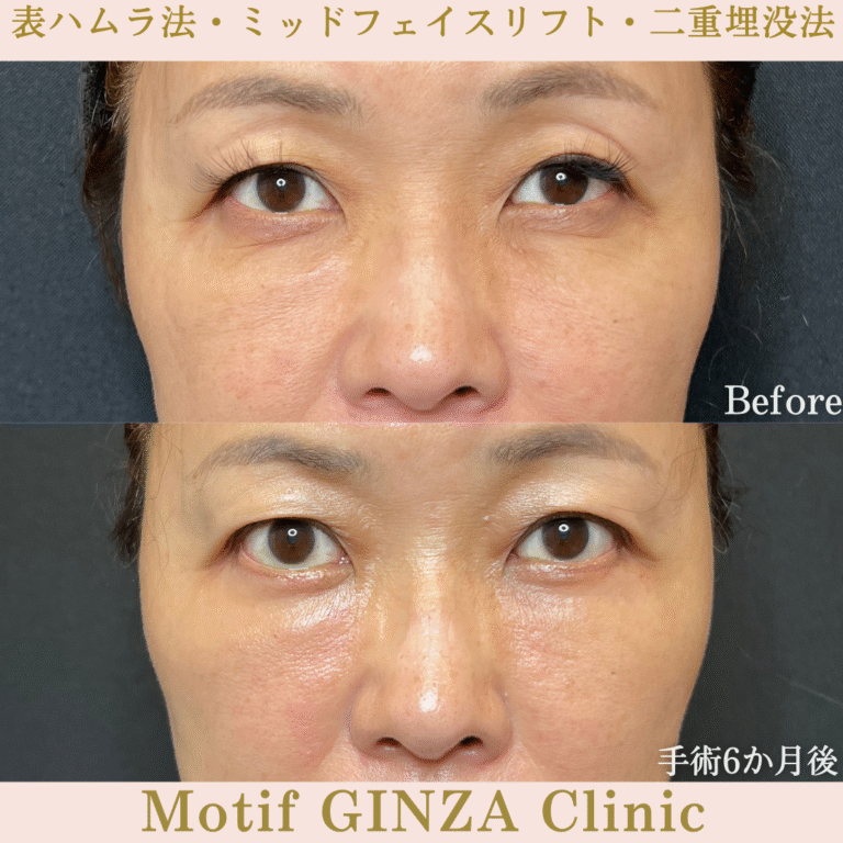 切開式下眼瞼たるみ取り・ミッドフェイスリフト・二重埋没法（手術６か月）