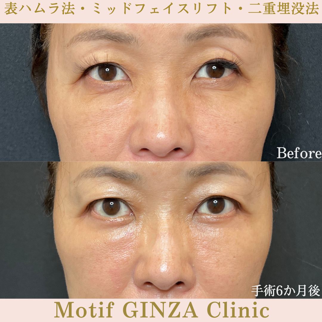 切開式下眼瞼たるみ取り・ミッドフェイスリフト・二重埋没法（手術６か月）の写真