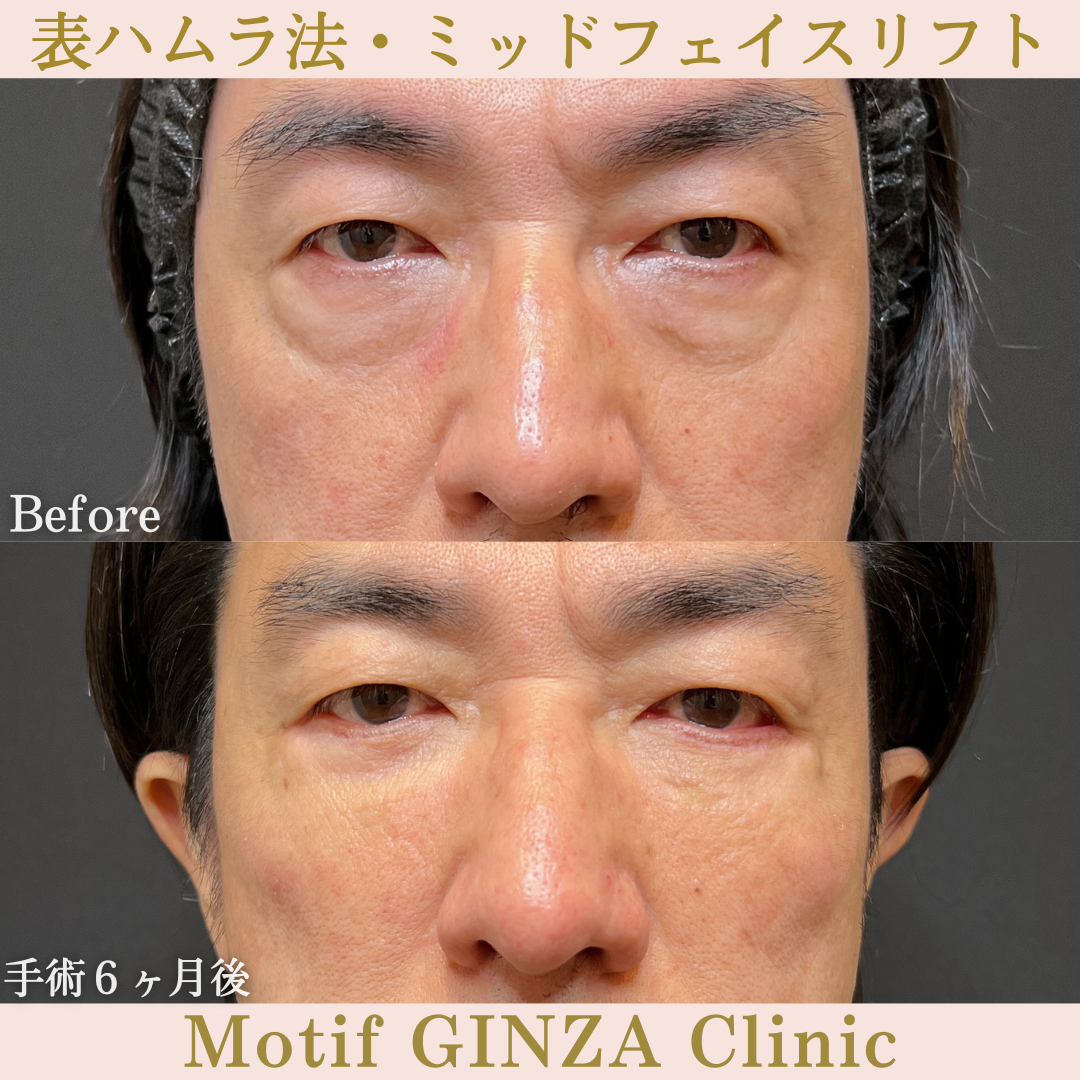 切開式下眼瞼たるみ取り・ミッドフェイスリフト（手術６ヶ月）の写真