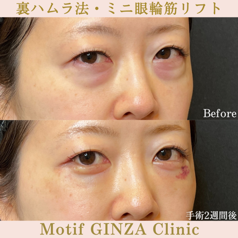 裏ハムラ法・ミニ眼輪筋リフト(手術1か月)の写真4