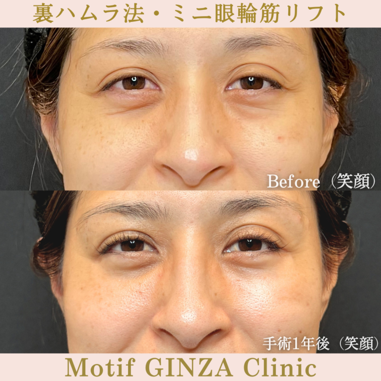 裏ハムラ法・ミニ眼輪筋リフト（手術1年）の写真2
