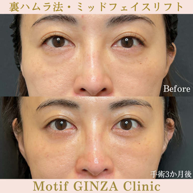 裏ハムラ法・ミッドフェイスリフト（手術３か月）