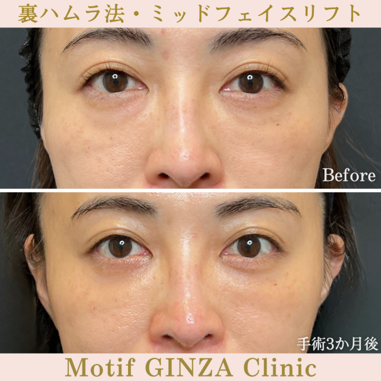 裏ハムラ法・ミッドフェイスリフト（手術３か月）