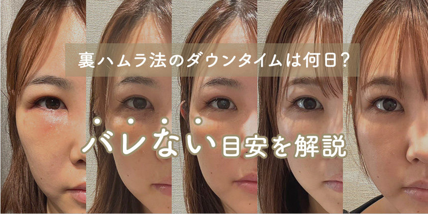 裏ハムラ法のダウンタイムは何日？術後4時間〜14日目の経過・バレない目安を解説