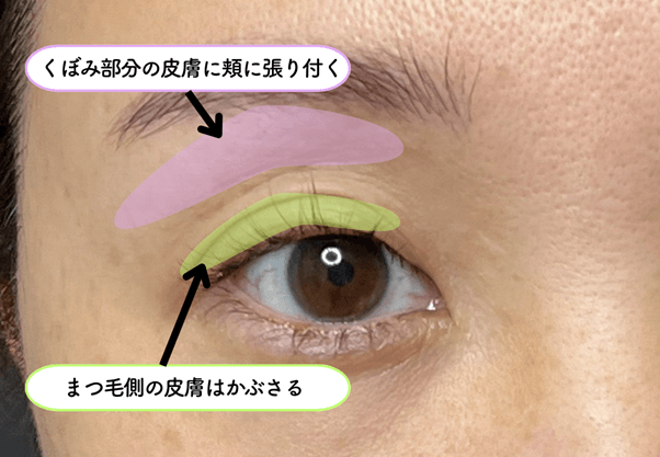 加齢で二重の折り込みが浅くなり上まぶたがくぼんで見える仕組みの解説図