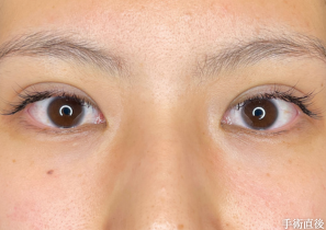 二重埋没法 術後直後のまぶたの腫れ(ダウンタイム経過)