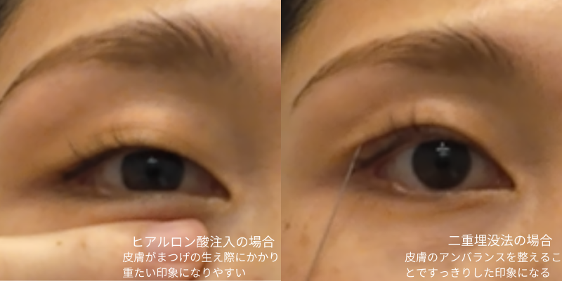 くぼみ目治療におけるヒアルロン酸注入と二重埋没法の印象の違い
