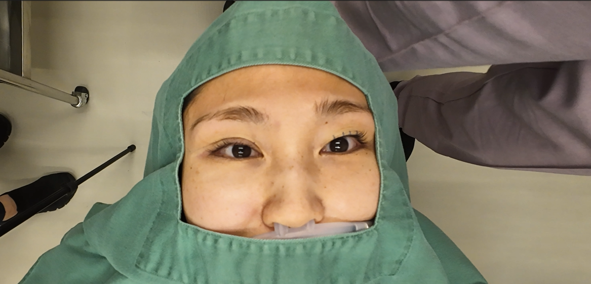 二重埋没法で片目の施術が終わった直後の様子