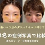 【美容外科専門医が解説】裏ハムラ法のダウンタイムは何日？腫れのピーク・仕事復帰の目安を4名の症例写真で比較