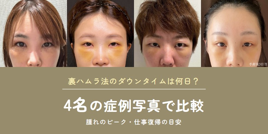【美容外科専門医が解説】裏ハムラ法のダウンタイムは何日？腫れのピーク・仕事復帰の目安を4名の症例写真で比較