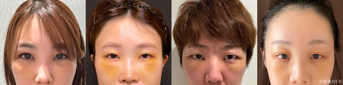 裏ハムラ法 術後3日目の4名の比較写真（腫れ・内出血の程度の違い）